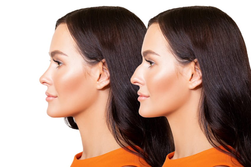 Simulation avant et après une rhinoplastie sur une femme