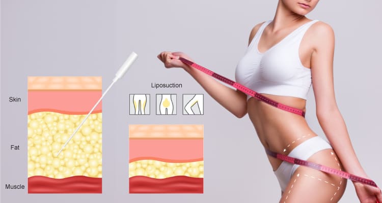 Schéma d'une canule aspirant des cellules graisseuse