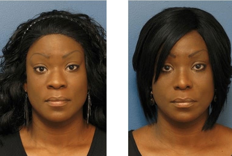 Photo avant et après d'une rhinoplastique ethnique sur femme de type afro