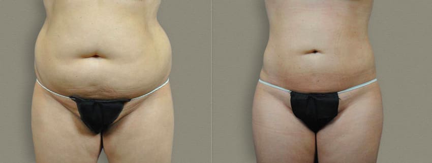 Photo avant et après d'une Mommy Makeover en Turquie