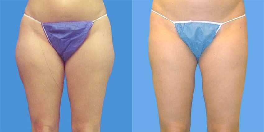 Liposuccion des cuisses en Turquie : Photo avant et après
