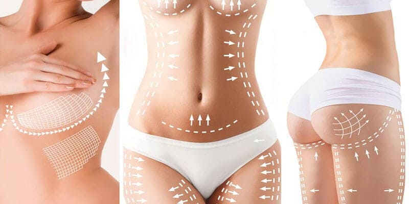 Tracé pour un Mommy Makeover