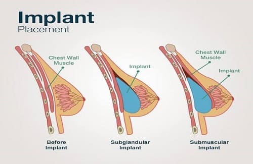 Schema de implantare a protezelor mamare sub și peste mușchi