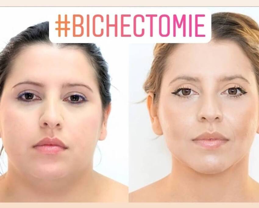 Photo avant et après d'une bichectomie