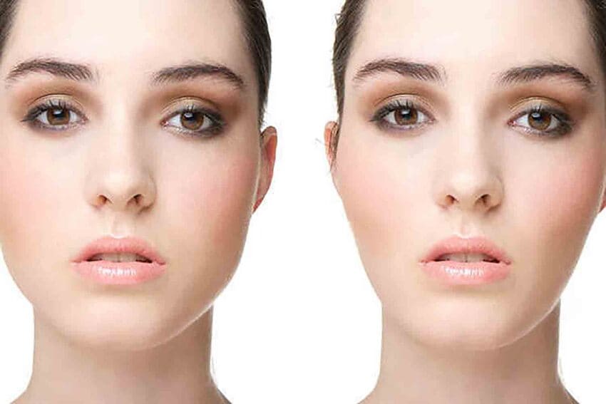 Simulation Photo avant et après d'une bichectomie