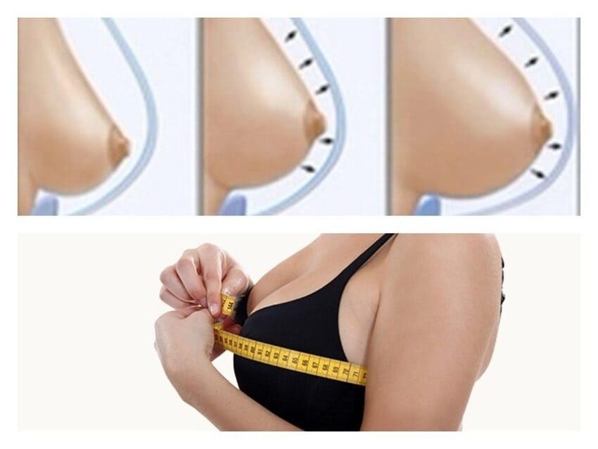 Simulation avant et après une augmentation mammaire