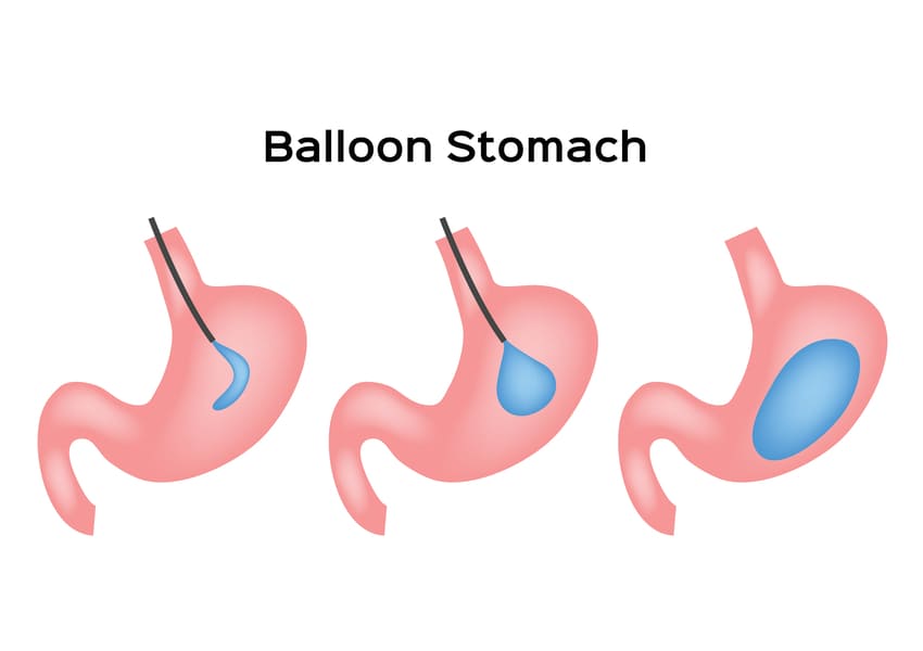 Schéma de la pose d'un ballon gastrique