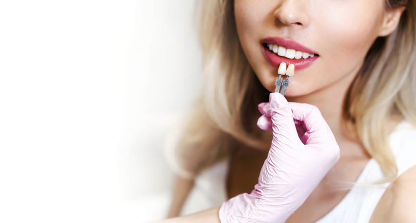 Choix de teinte de facette dentaire Lumineers