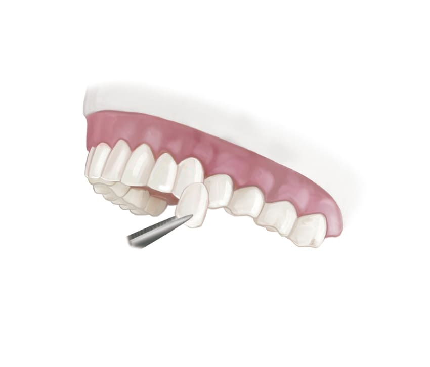 Schéma d'une pose d'une facette dentaire