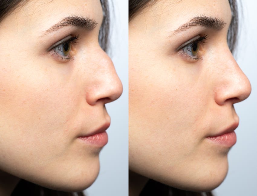 Simulation d'une rhinoplastie avant après